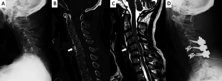 Radiograph, CT and MRI of fixed C4–C6 postlaminectomy kyphosis, and a lateral radiograph with short posterior screw fixation