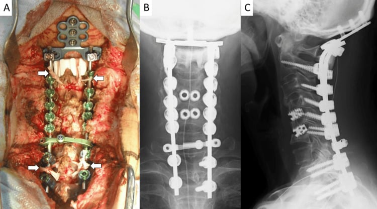 Occiput-to-T2 posterior reconstruction with anterior cervical cages for severe cervical kyphosis
