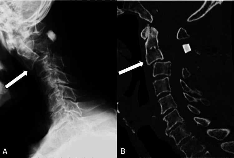 C2–C3 subluxation and progressive kyphosis after cervical laminoplasty