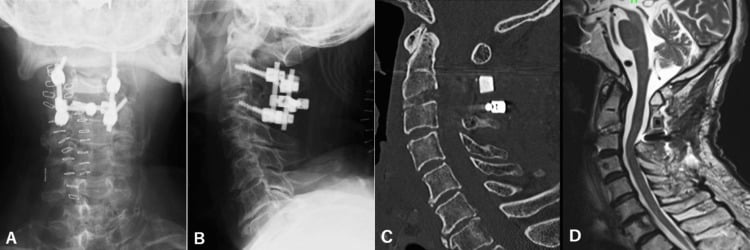 Circumferential (anterior and posterior, per the source) revision restoring cervical alignment after an iatrogenic slip, on radiographs, CT and MRI