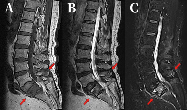 Sagittal T1, T2, and STIR MRI of Chance flexion-distraction injury