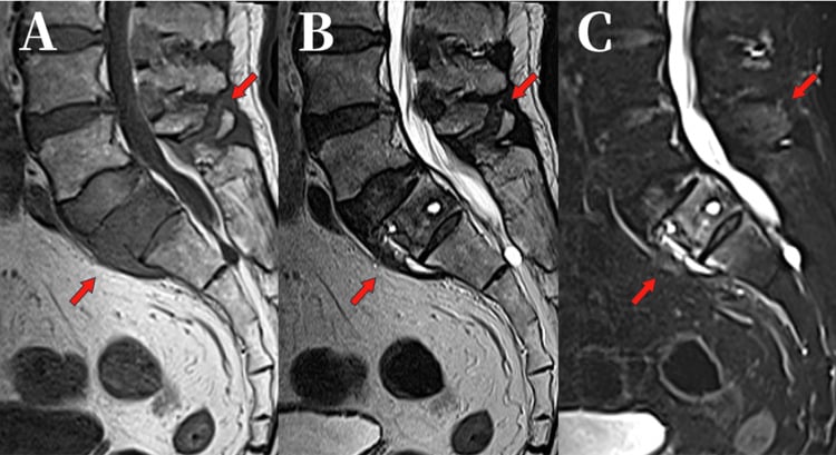 Sagittal T1, T2, and STIR MRI showing posterior ligamentous complex edema in Chance fracture