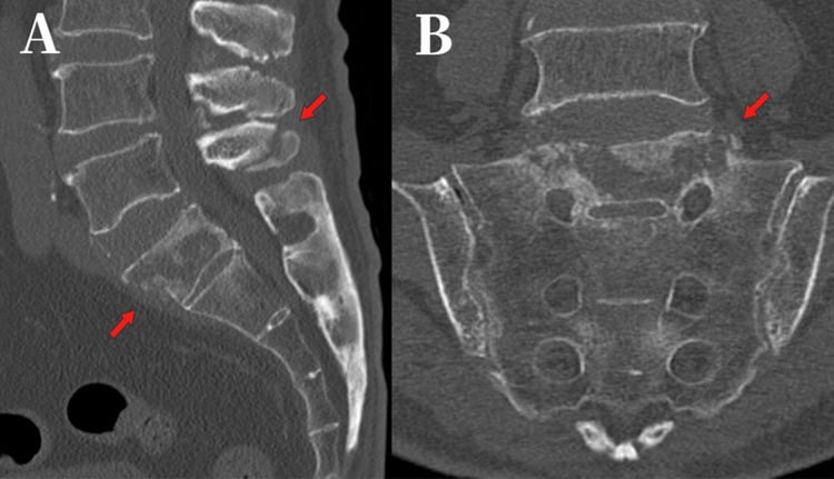 Sagittal and coronal CT views of Chance fracture horizontal fracture line