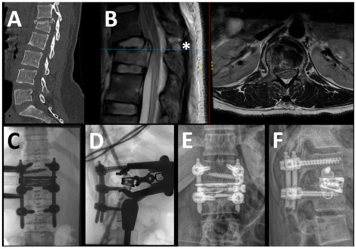 Sagittal CT, MRI, and postoperative radiographs of short-segment pedicle screw fixation for Chance fracture