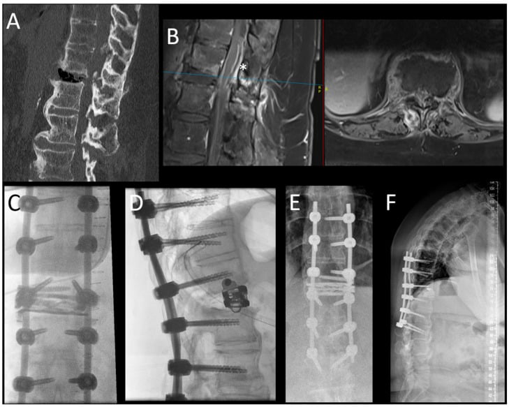 Preoperative CT/MRI and postoperative radiographs of pedicle screw instrumentation for Chance fracture