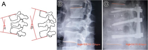 Schematic diagram of Cobb angle measurement and postoperative radiographs of Chance fracture fixation