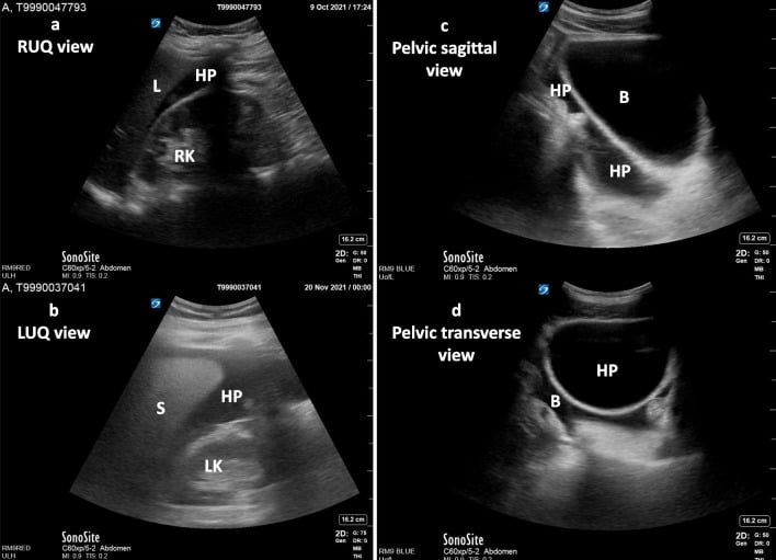 Abdominal FAST ultrasound demonstrating hemoperitoneum in seatbelt Chance fracture