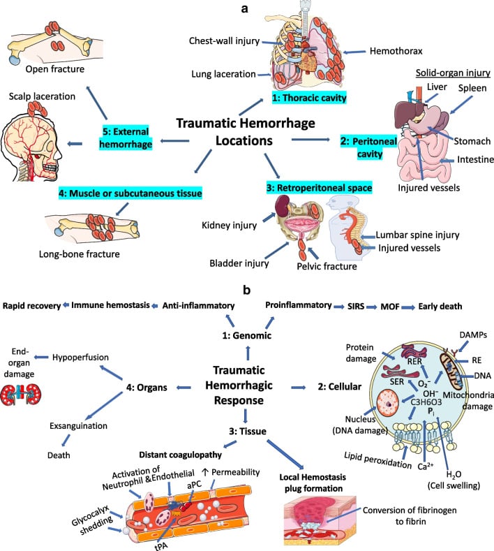 Anatomical diagram of traumatic hemorrhage sites and visceral injury in Chance fractures