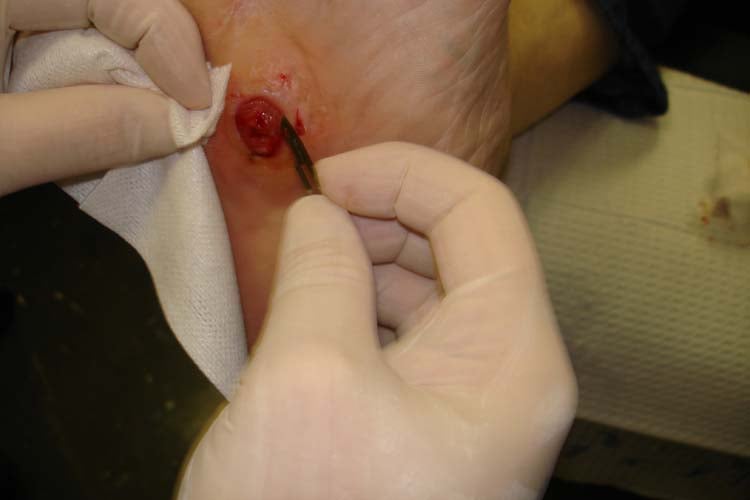 Neuropathic foot ulcer over a bony prominence probed to bone — the key Charcot complication and a bedside test for underlying osteomyelitis.