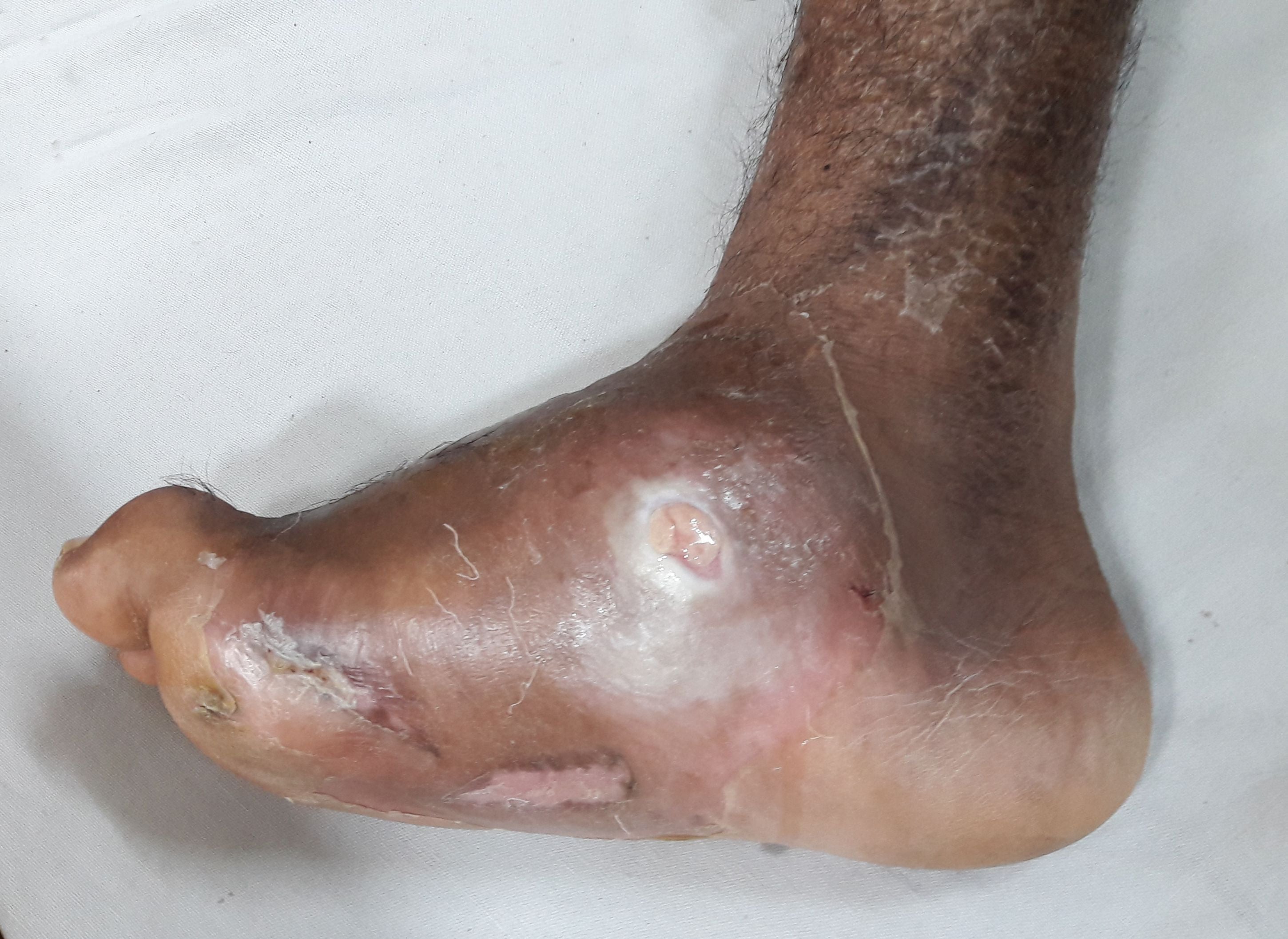 Charcot foot: collapse of the medial arch into a convex 'rocker-bottom' midfoot with a plantar bony prominence, callus and dry neuropathic skin.