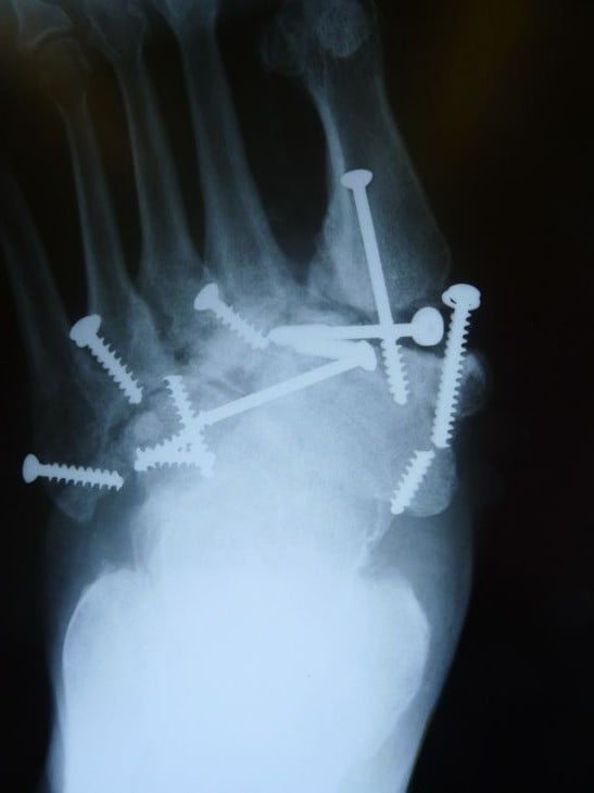 Foot radiograph after Charcot midfoot reconstruction with multiple screws.