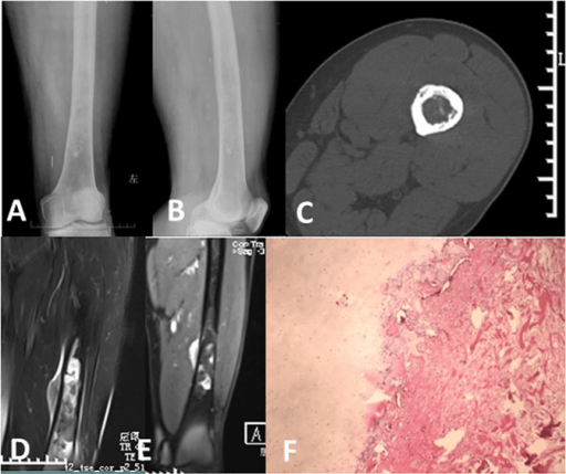 Grade-classification imaging of bone chondrosarcoma across radiograph, CT, MRI and histology.