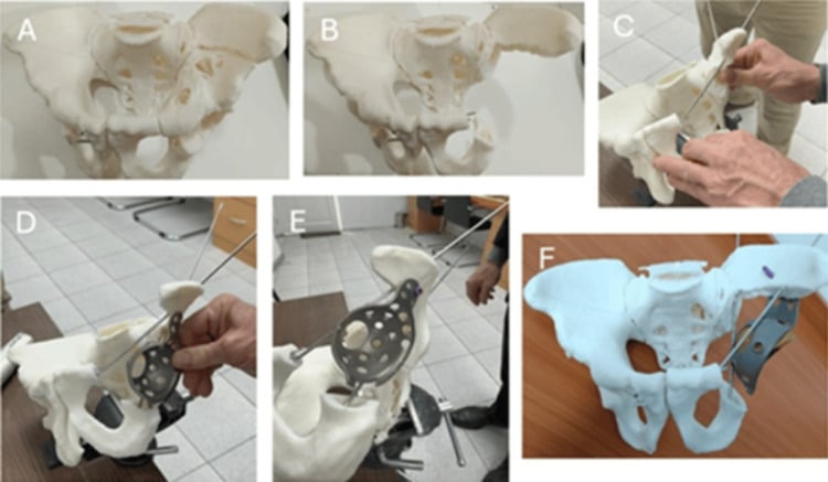 Stepwise three-dimensional pelvic model showing planned osteotomies and custom acetabular reconstruction.