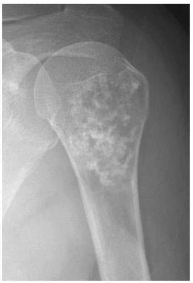 Shoulder radiograph showing an atypical cartilaginous tumour of the humerus with ring-and-arc mineralisation.