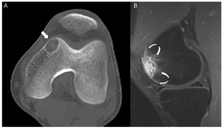 CT and contrast-enhanced MRI of clear cell chondrosarcoma in the distal femoral epiphysis.