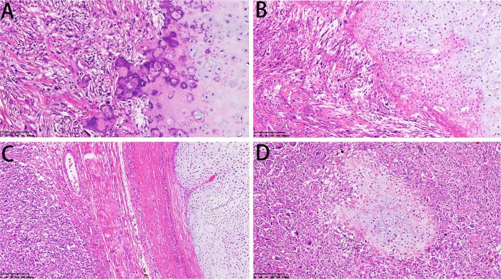 Histology panels showing juxtaposed cartilage and high-grade sarcoma in dedifferentiated chondrosarcoma.