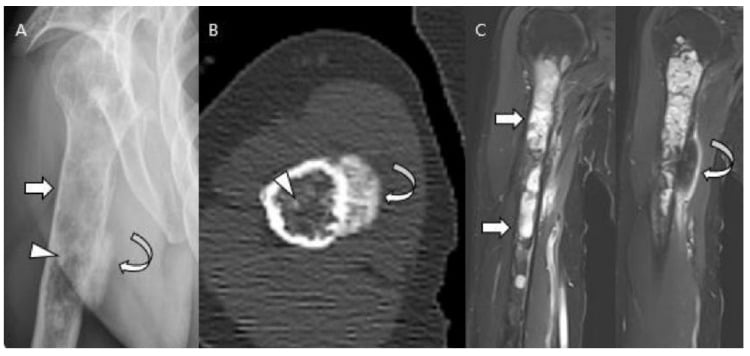 Radiograph, CT and MRI showing dedifferentiated chondrosarcoma of the humerus.