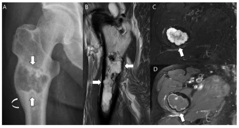 Radiograph and MRI of grade 2 chondrosarcoma in the proximal femur.