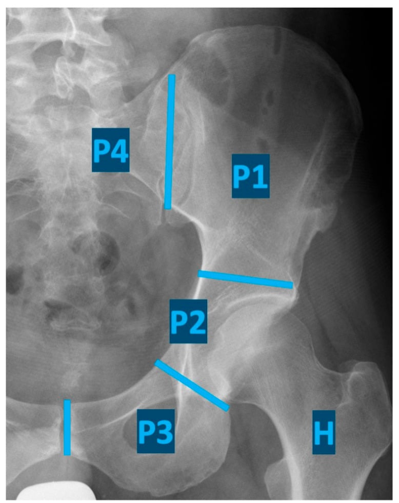Pelvic management pathway radiograph labelled with the Enneking internal hemipelvectomy resection zones P1 to P4 and H.