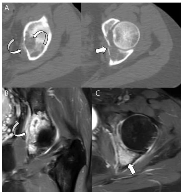 CT and contrast-enhanced MRI of high-grade acetabular chondrosarcoma.
