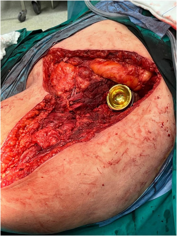 Tightly framed intraoperative field after internal hemipelvectomy with a LUMiC pedestal cup reconstruction.