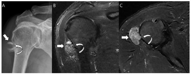 Radiograph and MRI of periosteal chondrosarcoma of the humerus.