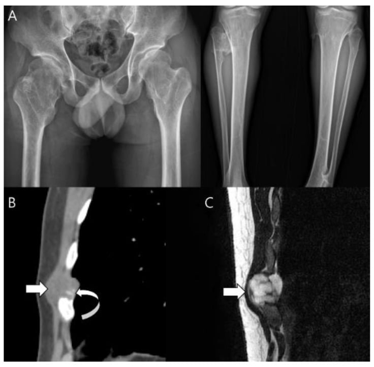 Radiographs, CT and MRI of secondary peripheral chondrosarcoma arising from a rib osteochondroma.