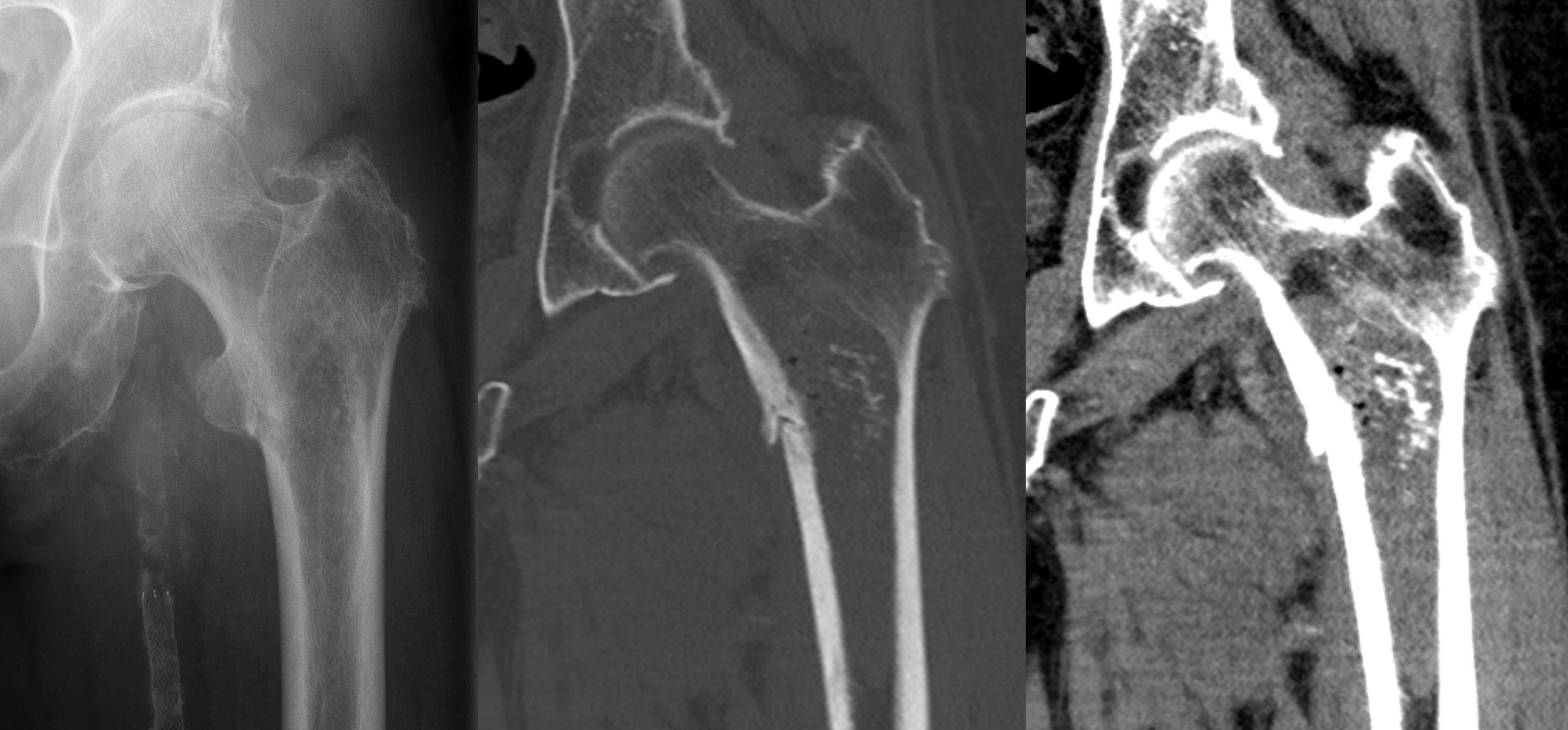 Radiograph and CT of a high-grade chondrosarcoma of the proximal femur.