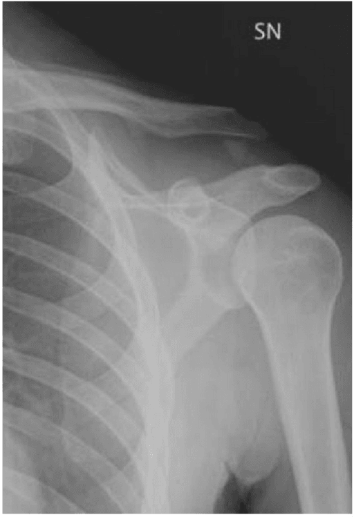 Type V lateral clavicle fracture on AP shoulder radiograph