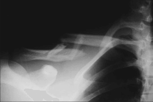 Mid-shaft clavicle fracture with AC joint dislocation representing floating shoulder variant