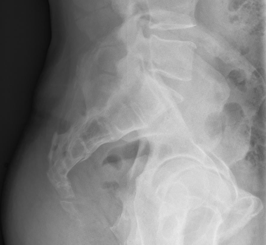 Lateral radiograph of the sacrum and coccyx showing anterior angulation of the coccyx, a fracture/dislocation pattern that can cause coccydynia.