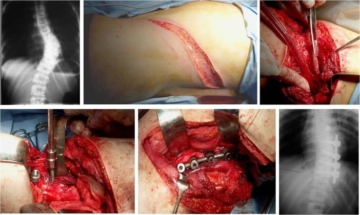 Six-panel figure: a preoperative AP radiograph of a curved spine, the skin incision, the exposed spine, screw insertion, the rod seated in the screw heads, and a postoperative AP radiograph with screws and rods in place.
