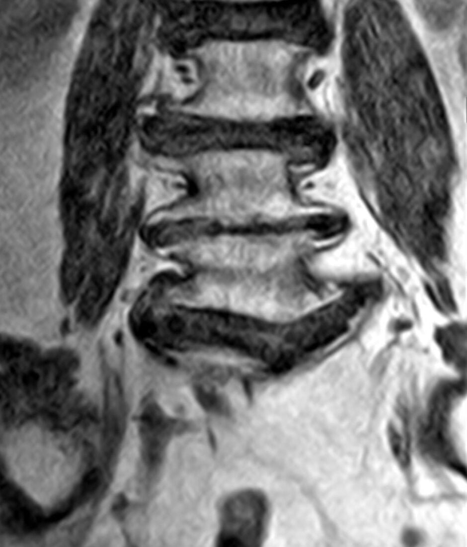 Coronal MRI of a butterfly vertebra: the lowest vertebral body in the frame is split in the midline into two wings of marrow.