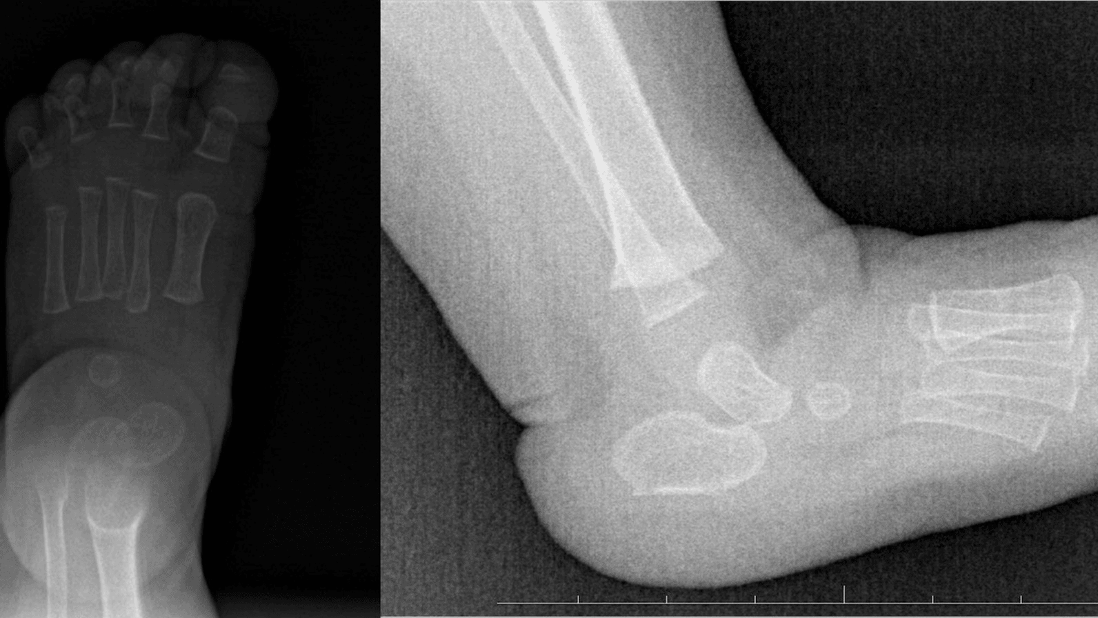 AP and lateral congenital vertical talus radiographs after five serial casts