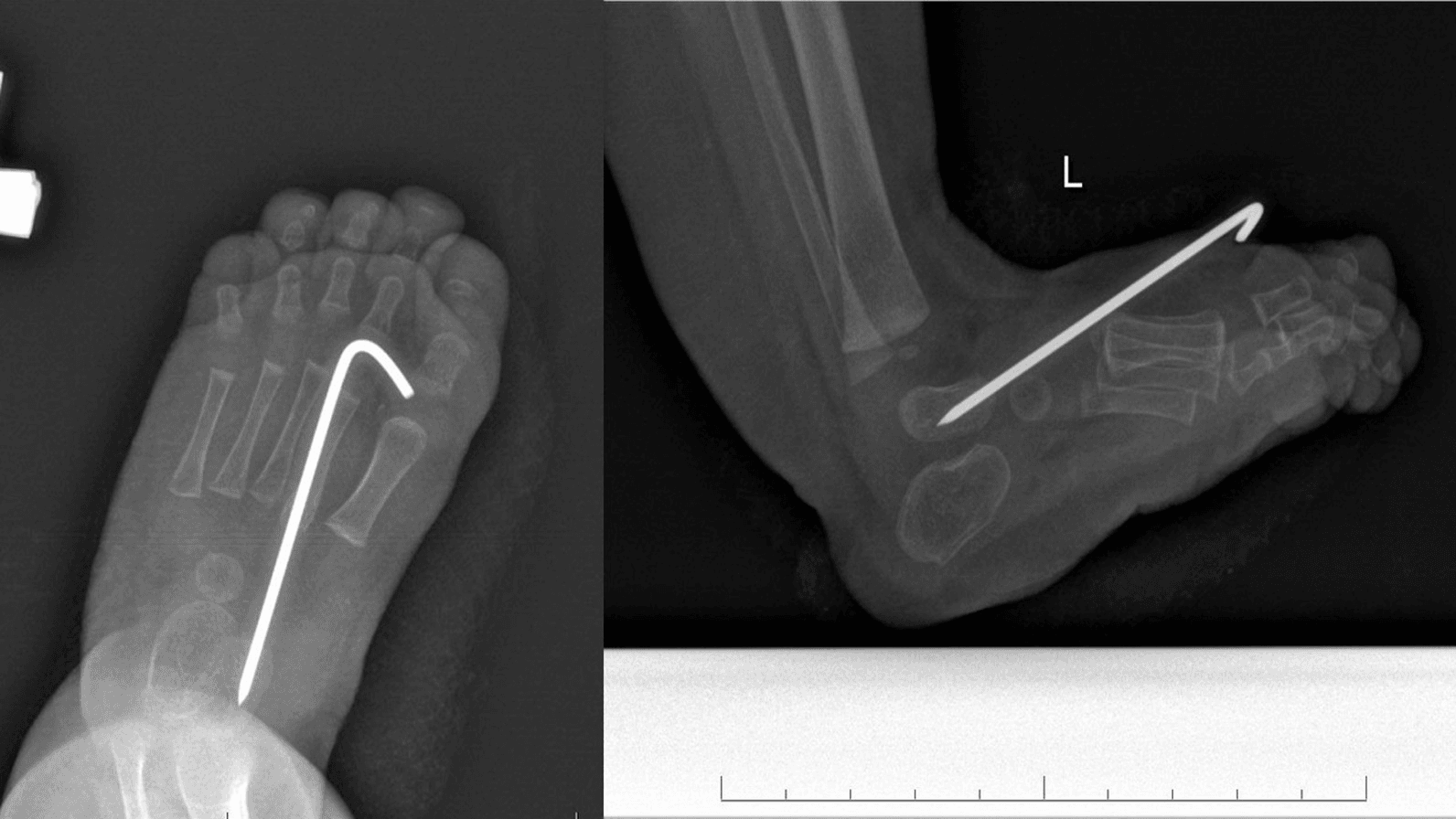 Immediate postoperative AP and lateral radiographs with talonavicular K-wire stabilisation