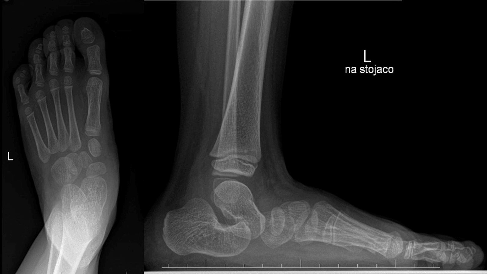 AP and lateral follow-up radiographs showing recurrent congenital vertical talus deformity