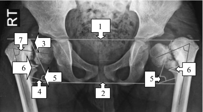 AP pelvis with Hilgenreiner epiphyseal angle, head–shaft angle and osteotomy planning lines marked by numbered arrows 1 to 7