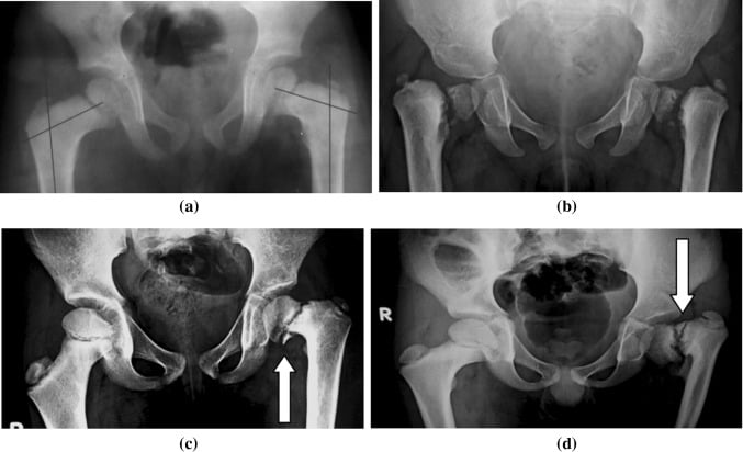 Four AP pelvic radiographs, panels a to d, showing rachitic, developmental and unilateral coxa vara patterns