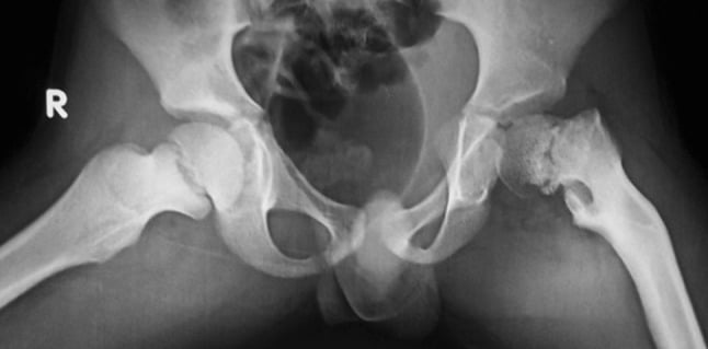 Frog-lateral radiograph showing unilateral developmental coxa vara with proximal-femoral dysplasia