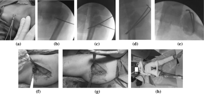 Operative and fluoroscopic sequence of paediatric intertrochanteric valgus osteotomy, panels a to h