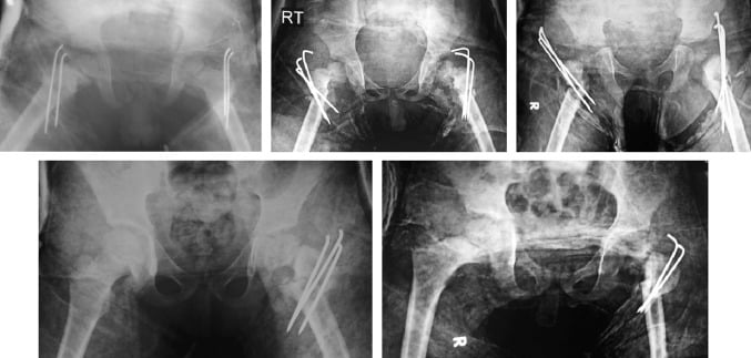 Postoperative AP pelvis radiographs after valgus osteotomy with bent transfixing wires, bilateral in three films and unilateral in two