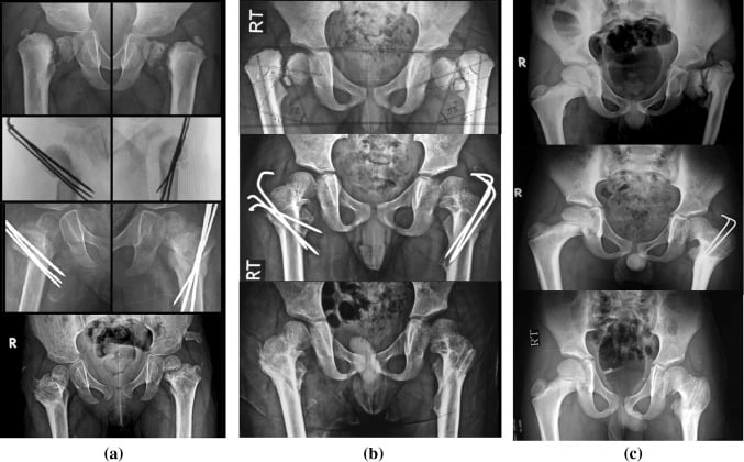 Radiographic outcomes after paediatric valgus osteotomy for developmental coxa vara, three columns a to c