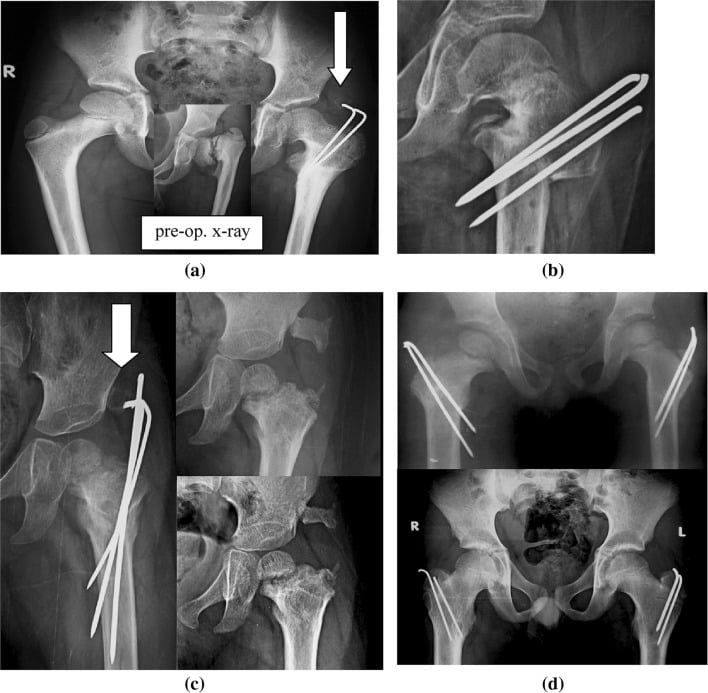 Serial radiographs showing physeal closure wire-related ossification displacement and residual coxa vara