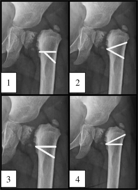 Radiograph of the same proximal femur in four panels, 1 to 4, each with an intertrochanteric osteotomy configuration drawn as two converging white lines