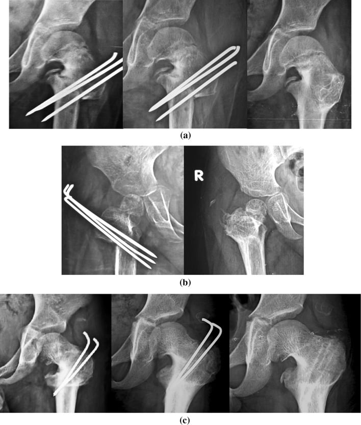 Serial radiographs showing proximal-femoral remodelling after valgus osteotomy