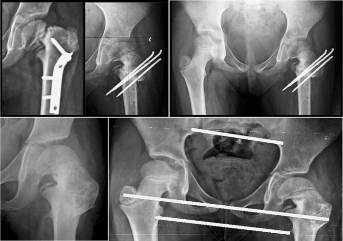 Radiographs showing failed prior fixation revision valgus osteotomy and healed correction