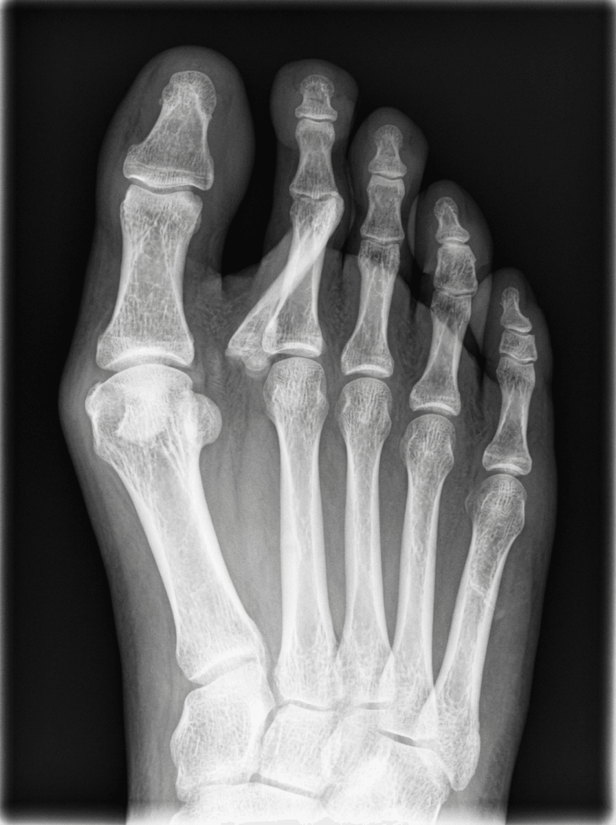 AP forefoot radiograph showing hallux valgus with the second toe deviated medially and crossing over the great toe.