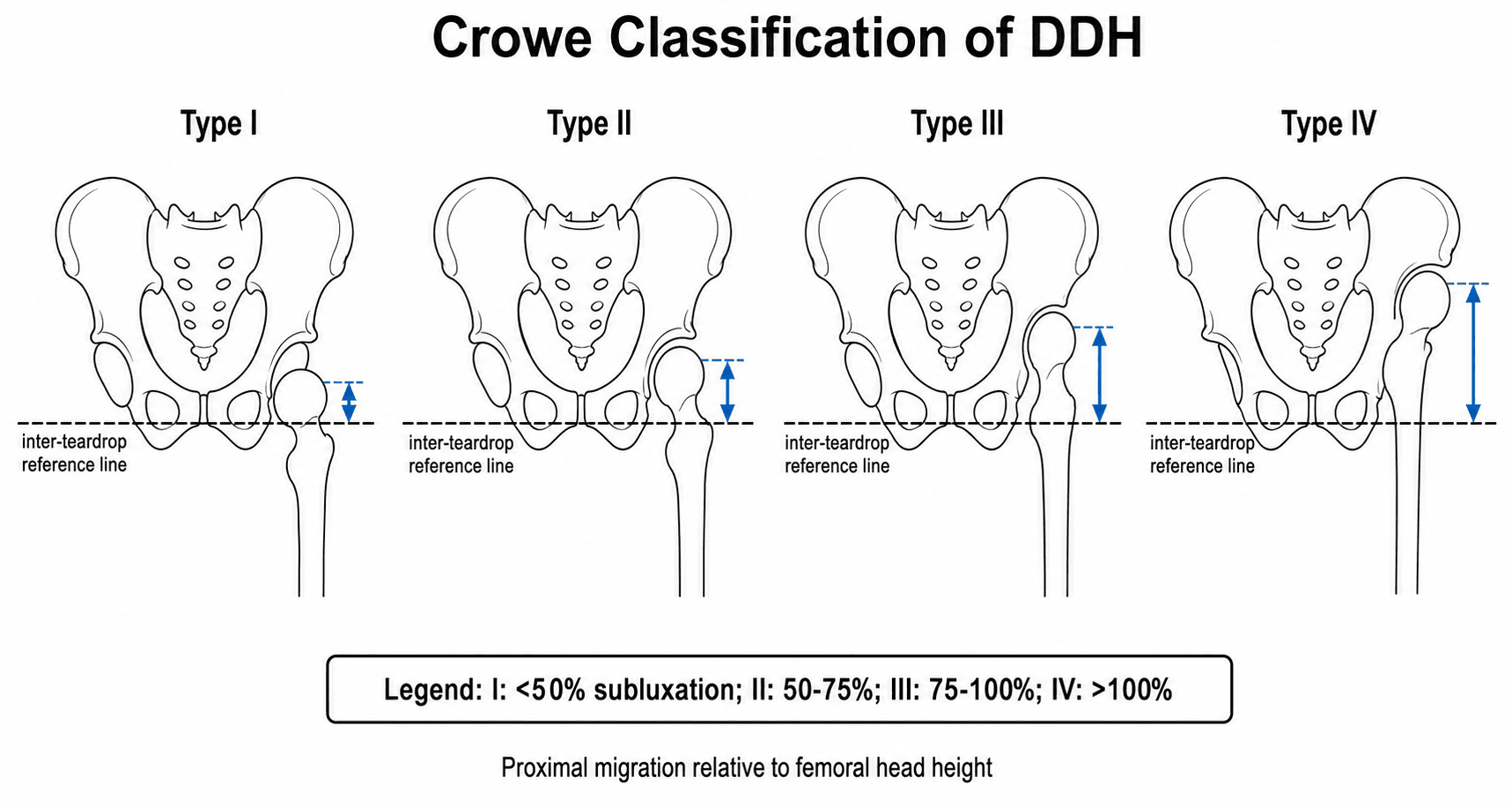 Crowe classification of DDH by proximal femoral migration: I under 50%, II 50-75%, III 75-100%, IV over 100% subluxation