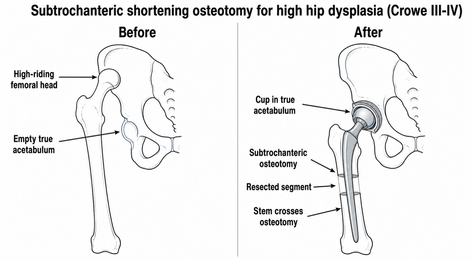 Two-panel before/after diagram: a high-riding dislocated dysplastic hip, then a THA with the cup in the true acetabulum and a subtrochanteric shortening osteotomy with a resected segment and a stem crossing the osteotomy.