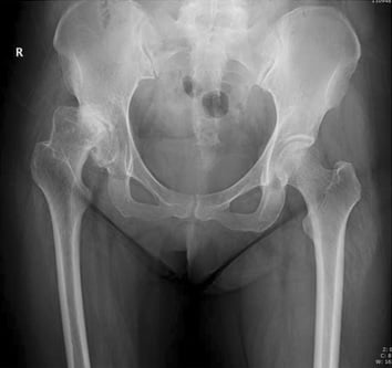 AP pelvis radiograph of an adult with developmental dysplasia of both hips showing shallow acetabula and poorly covered femoral heads.